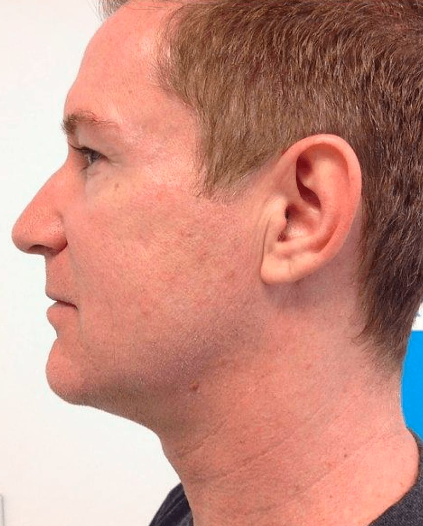 Ultrasound Skin Tightening After, Male 43 - 838