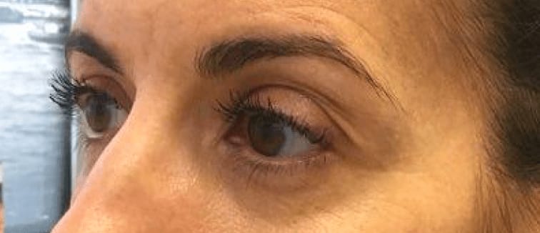 Chemical (Botox) Brow Lift After, Female 34 - 841