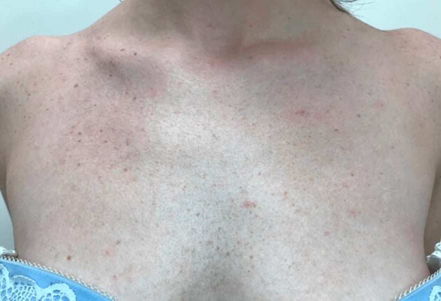 Ablative Erbium Laser Before, Female 34 - 844