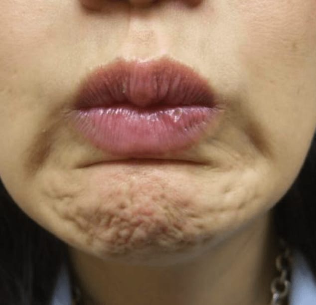 Botox for Dimpled Chin Before, Female 35 - 831