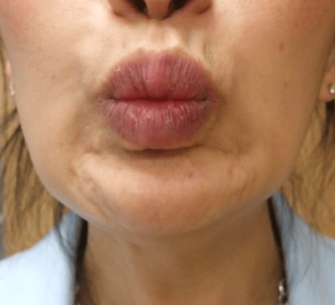 Botox for Dimpled Chin After, Female 35 - 831