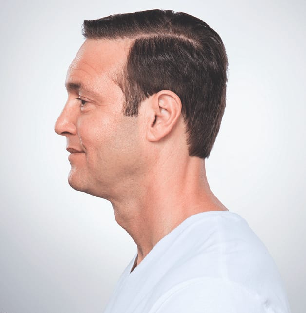 Kybella® After, Male 46 - 852