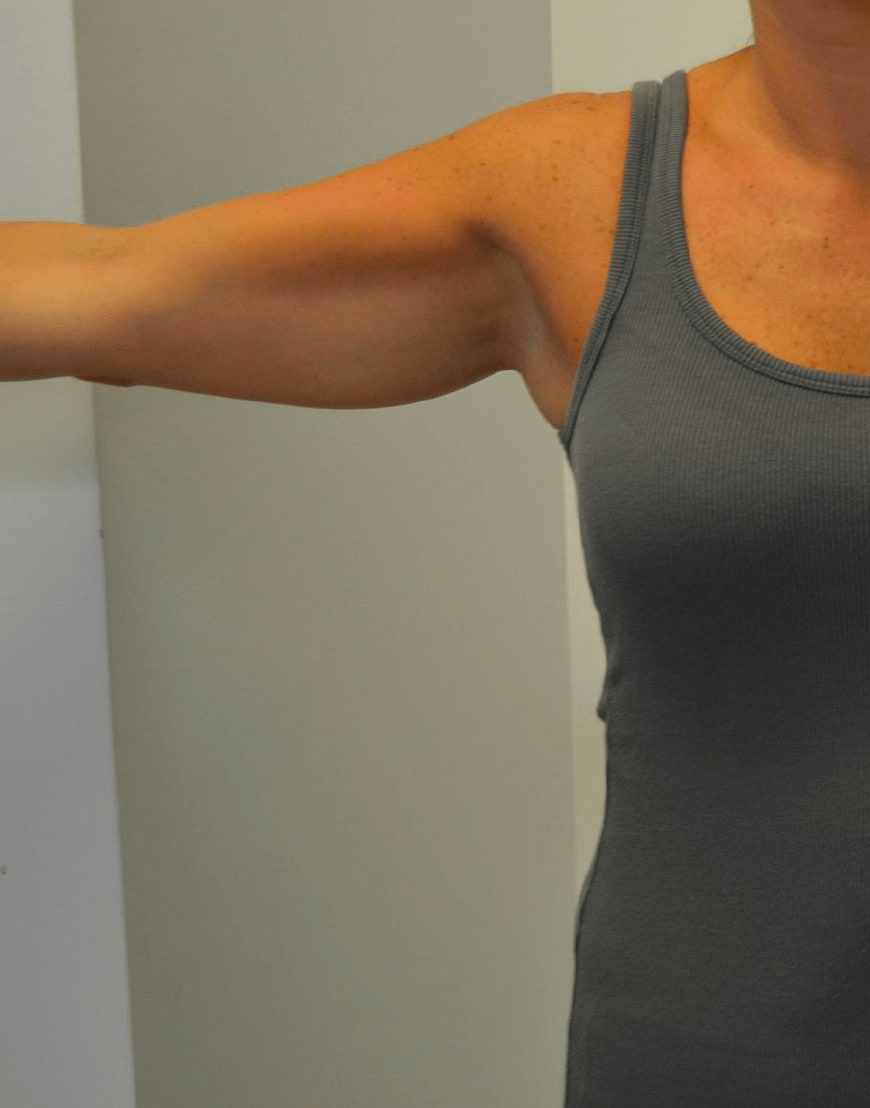 CoolSculpting® Before, Female 35 - 855