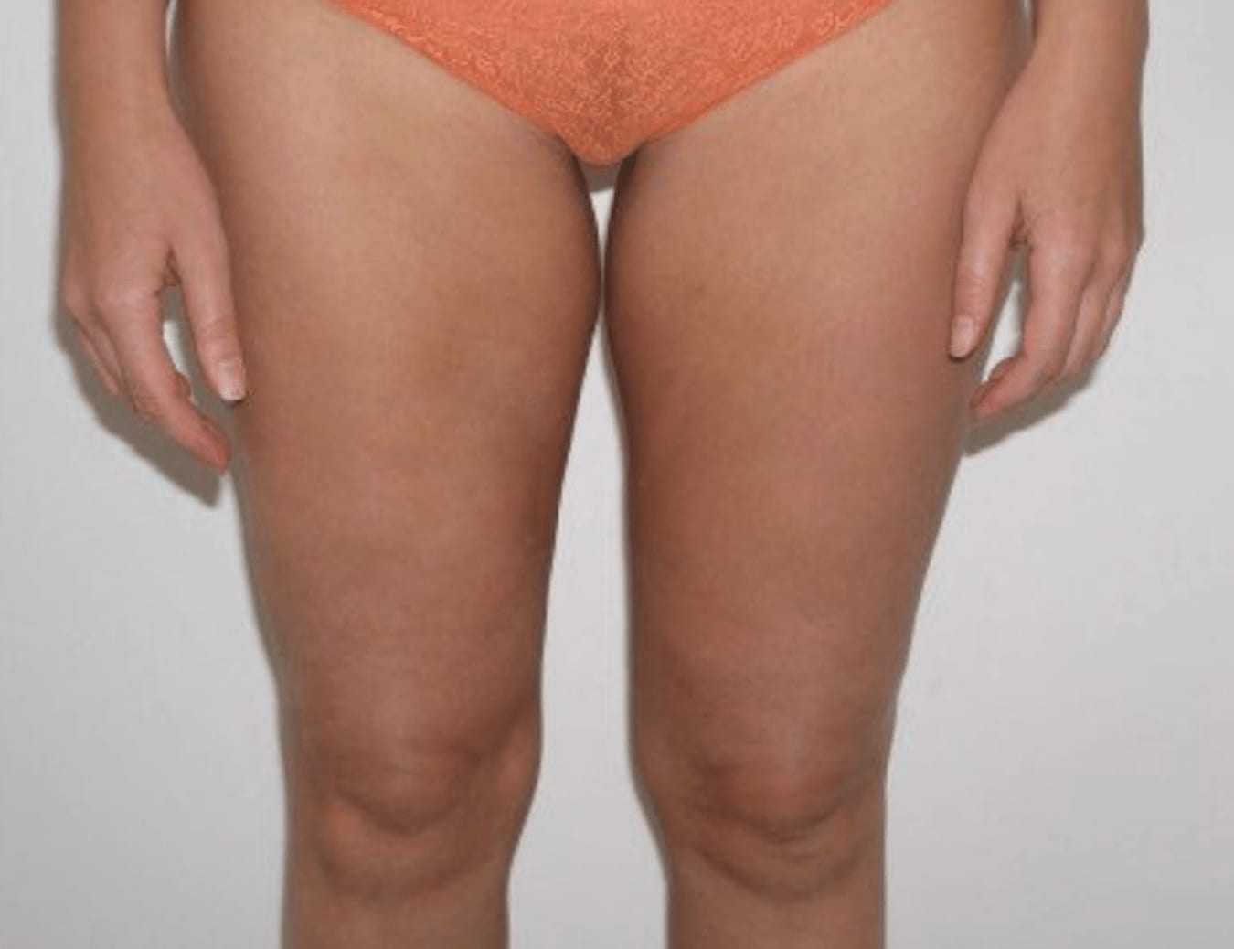 Liposuction After, Female 32 - 878