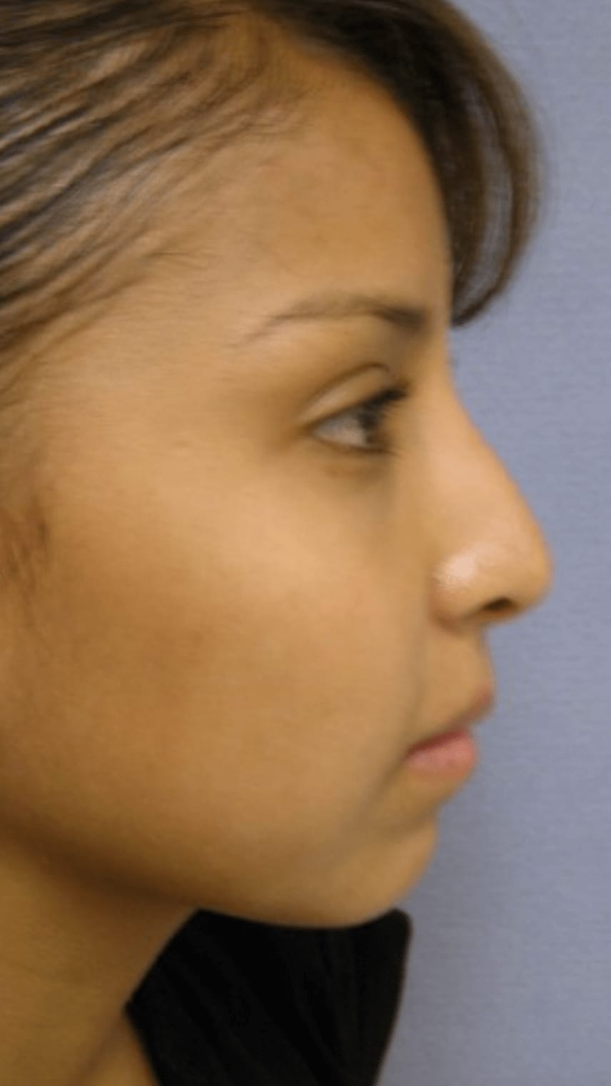 Rhinoplasty Before, Female 26 - 885
