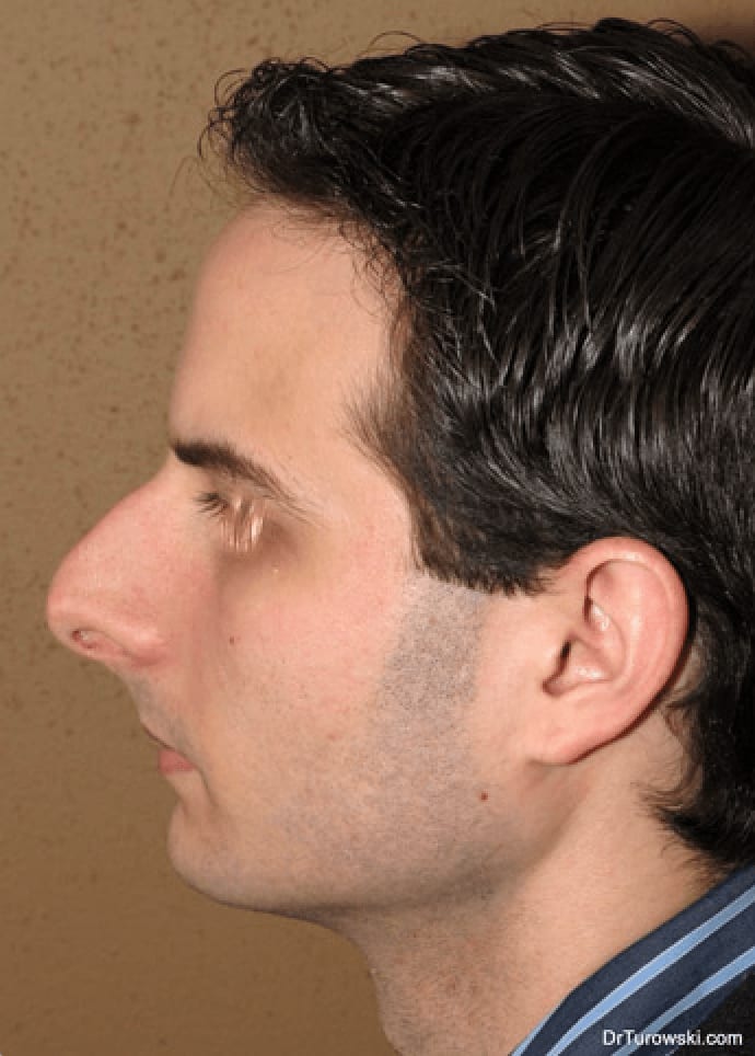 Rhinoplasty Before, Male 32 - 913