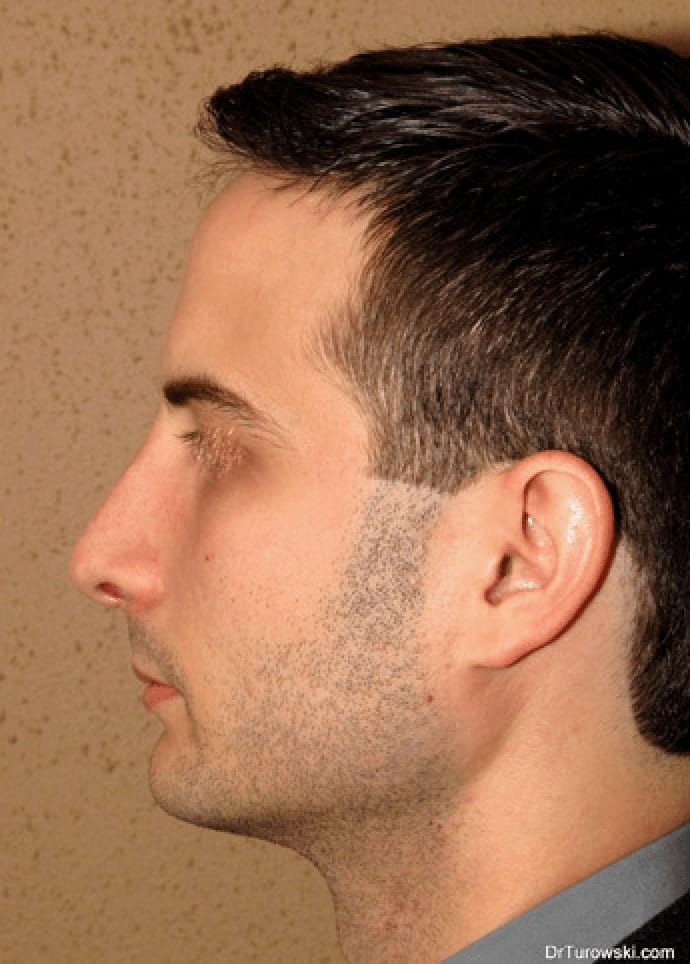 Rhinoplasty After, Male 32 - 913