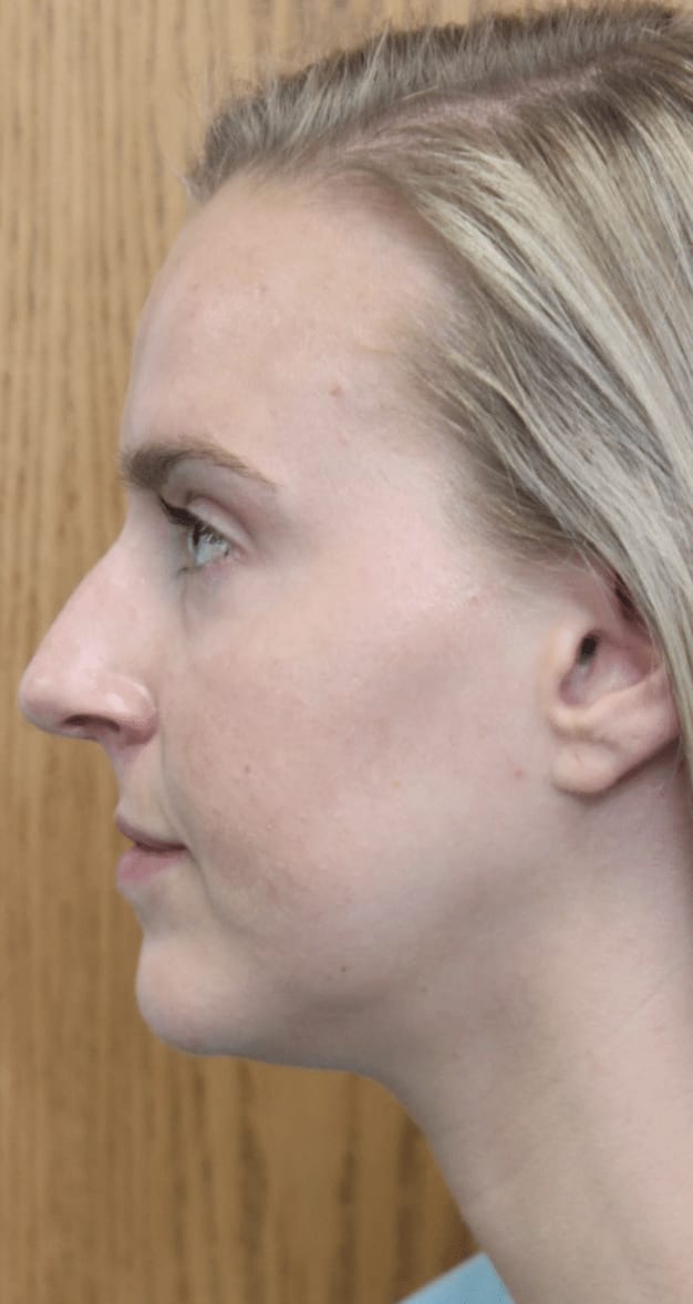 Chin Augmentation with Soft Tissue Fillers After, Female 26 - 980
