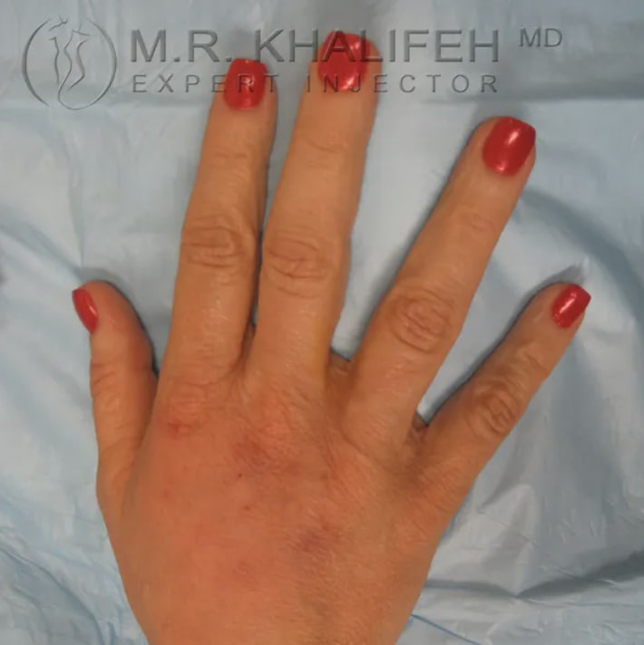 Dermal Fillers & Injectables Before, Female 45 - 1000