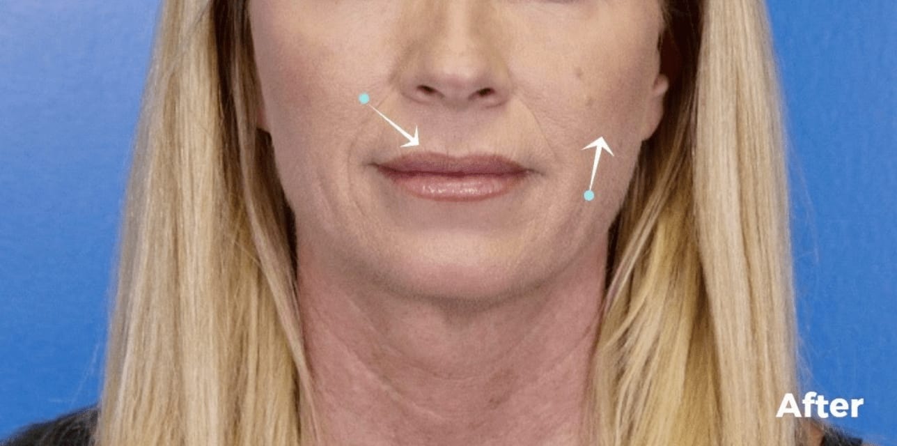 Laser Skin Resurfacing After, Female 35 - 1088