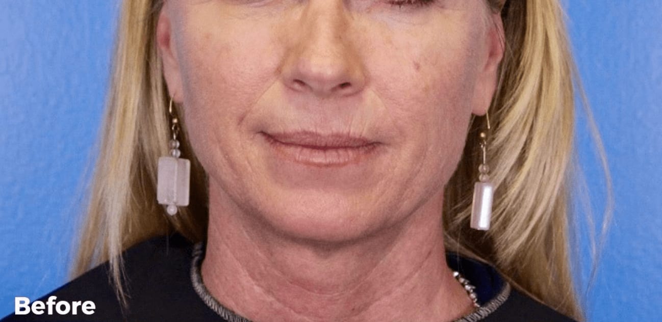 Laser Skin Resurfacing Before, Female 35 - 1088