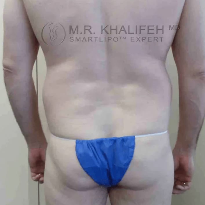SmartLipo Before, Male 34 - 1151