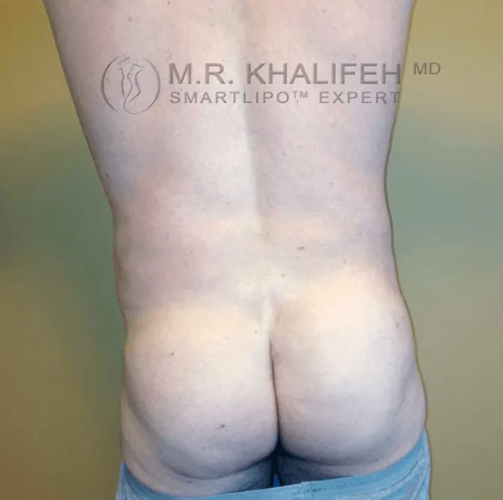SmartLipo After, Male 34 - 1151