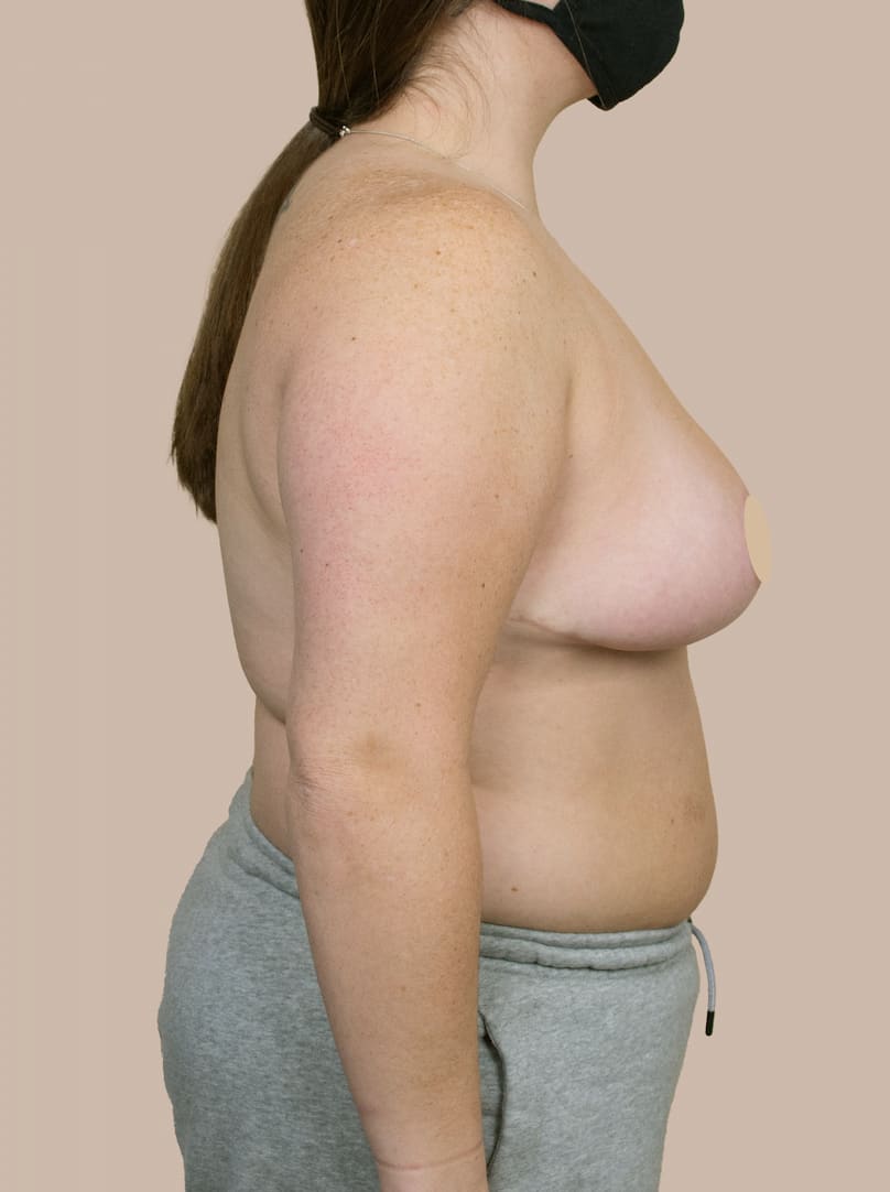 Breast Reduction After, Female 32 - 1369