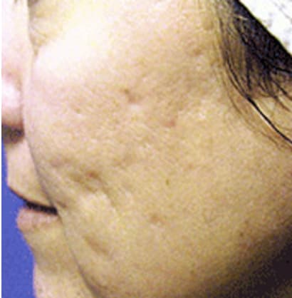Acne Scar Treatment Before, Female 43 - 1386
