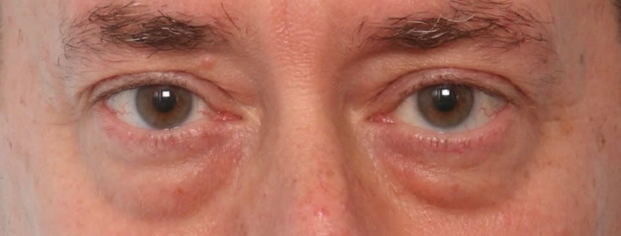 Blepharoplasty Before, Male 58 - 1466