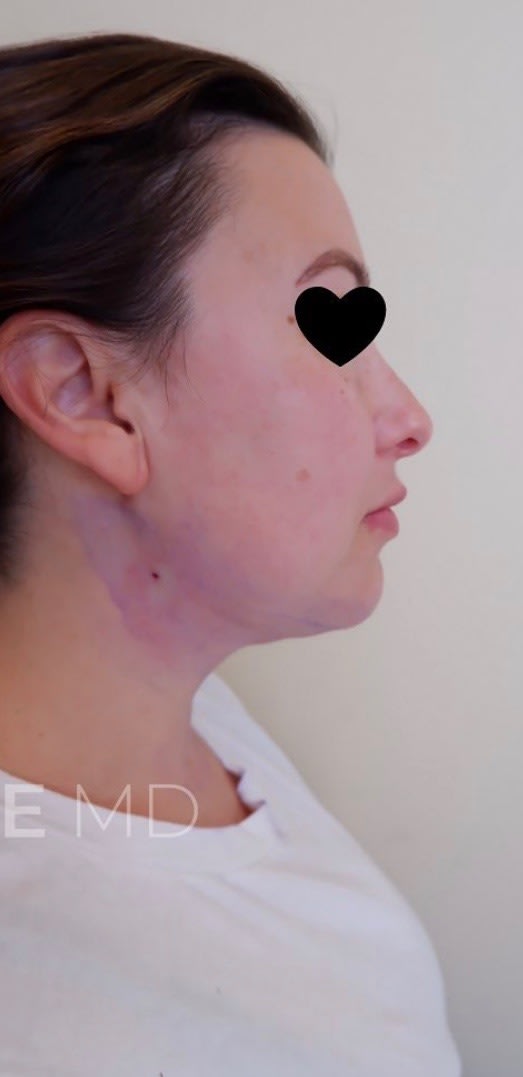 Thread Lift After, Female 37 - 1785