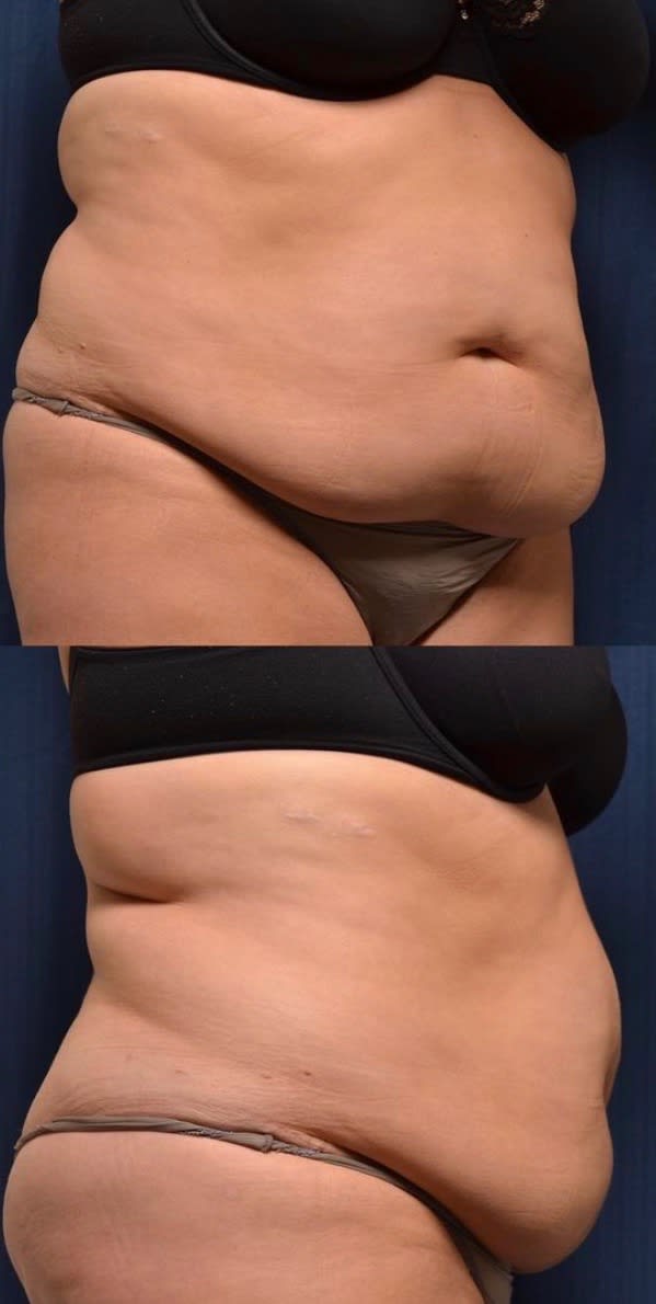 Tummy Tuck (Abdominoplasty) After, Female 44 - 1797