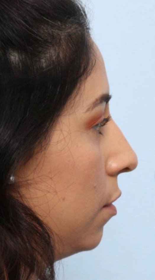 Liquid Rhinoplasty After, Female 33 - 1874