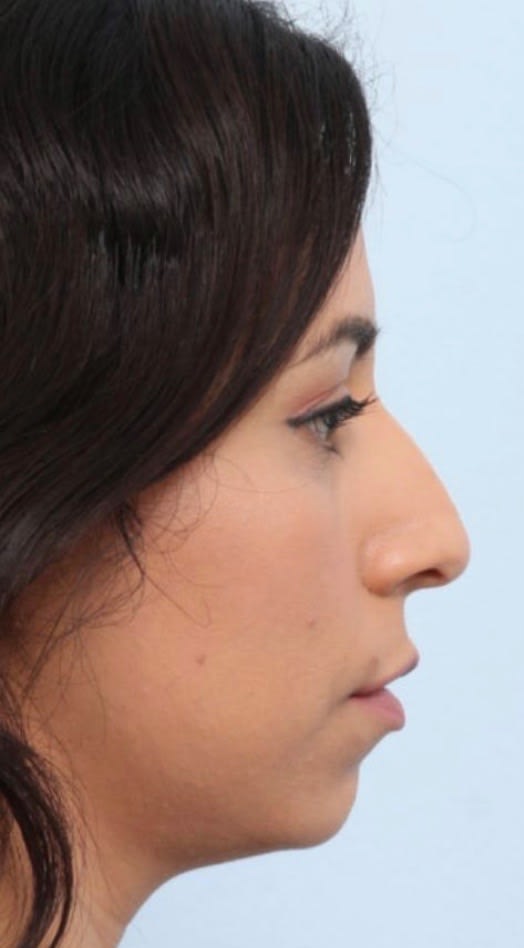 Liquid Rhinoplasty Before, Female 33 - 1874