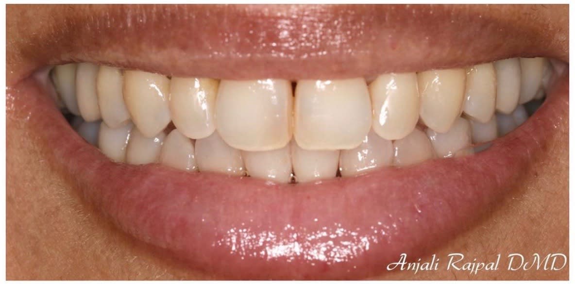 Invisalign® After, Female 54 - 1923