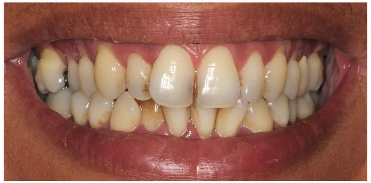 Invisalign® Before, Female 54 - 1923