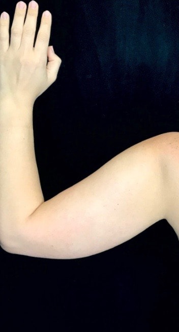 Liposuction Before, Female 30 - 2236