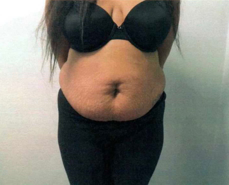 Liposuction Before, Female 33 - 2250