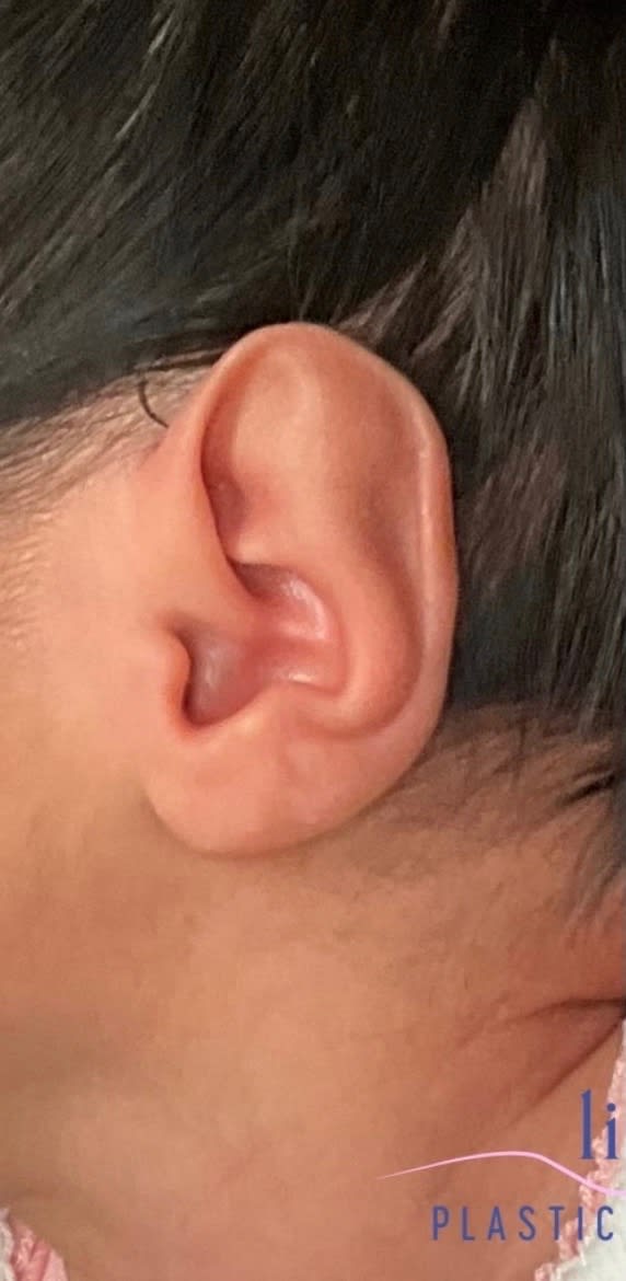 Ear Surgery (Otoplasty) Before, Female 1 - 2850