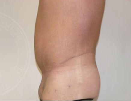 Abdominal Slimming Solutions After, Male 42 - 3135