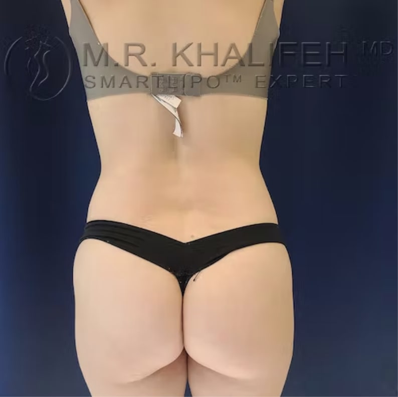 Liposuction After, Female 33 - 3170