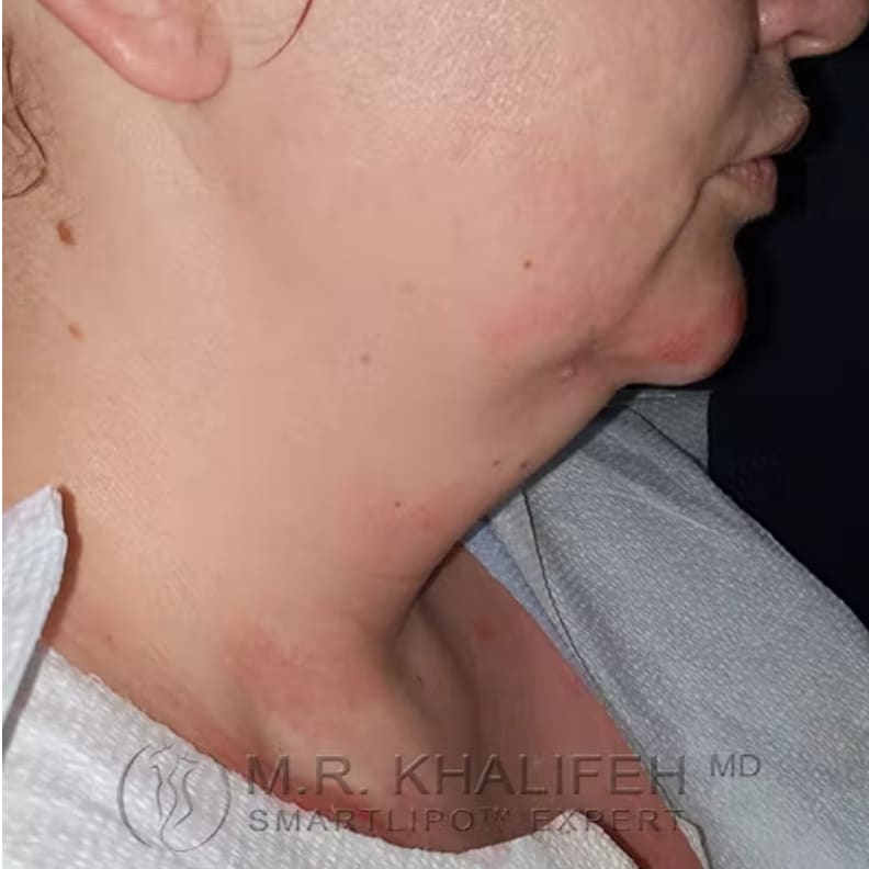 Laser-Assisted Liposuction Before, Female 39 - 3173