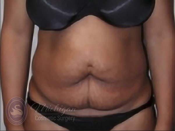 Tummy Tuck (Abdominoplasty) Before, Female 43 - 3459
