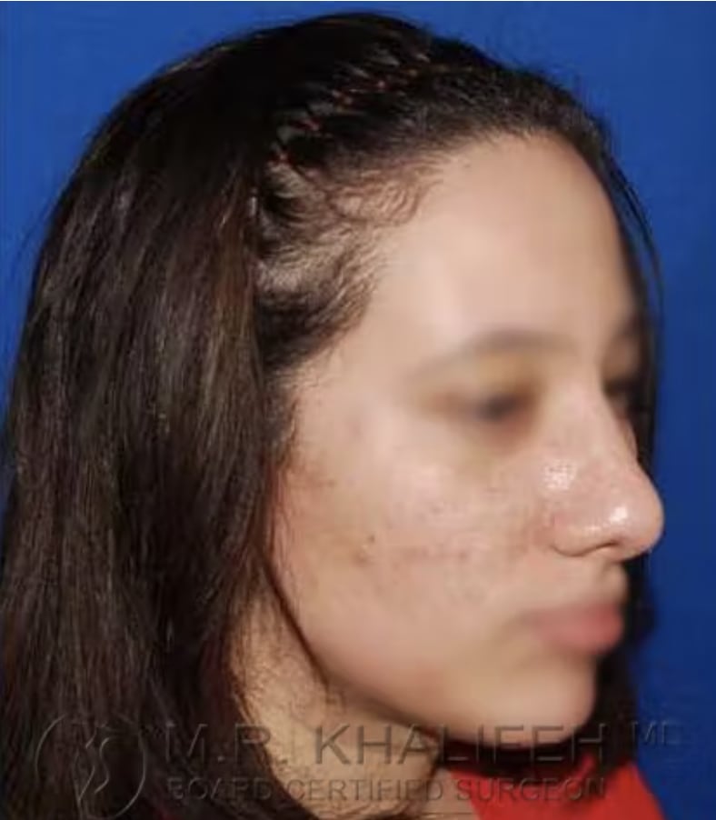 Rhinoplasty After, Female 36 - 3551
