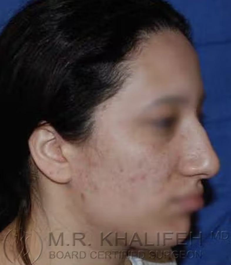 Rhinoplasty Before, Female 36 - 3551