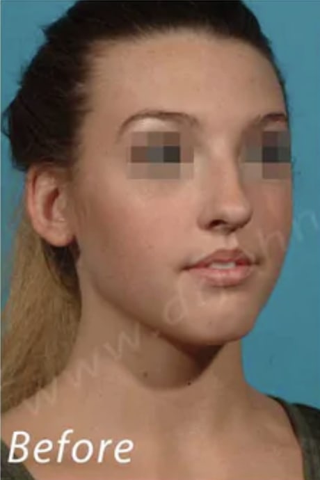 Rhinoplasty Before, Female 23 - 3554