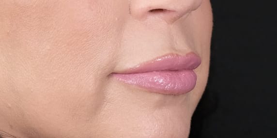 Lip Lift Before, Female 56 - 1527