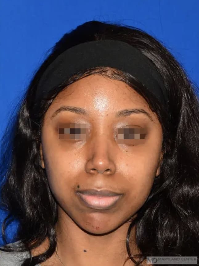 Chin Enhancement Solutions After, Female 33 - 3610