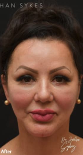 Chin Augmentation After, Female 52 - 3622