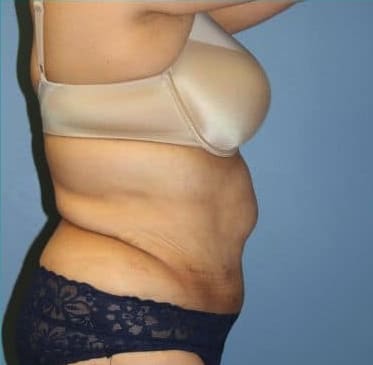Tummy Tuck (Abdominoplasty) After, Female 40 - 3714