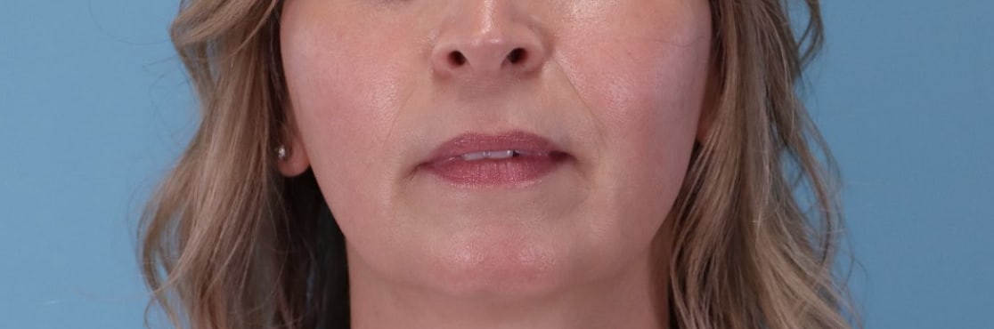 Lip Augmentation and Injections Before, Female 52 - 3731