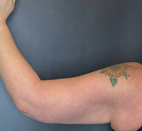 Arm Lift After, Female 44 - 3747