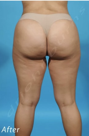 Brazilian Butt Lift After, Female 34 - 3752