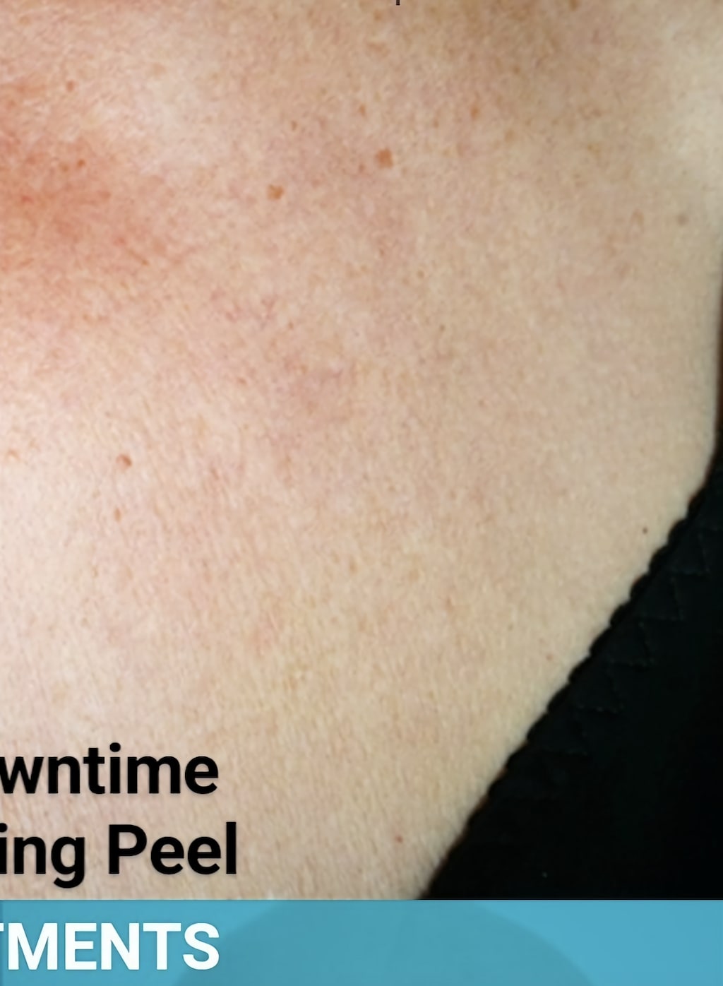 Chemical Peels After, Female 52 - 3757