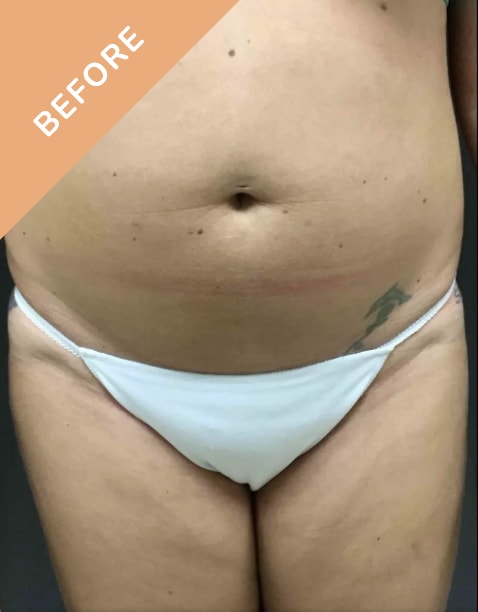 Liposuction Before, Female 40 - 3808