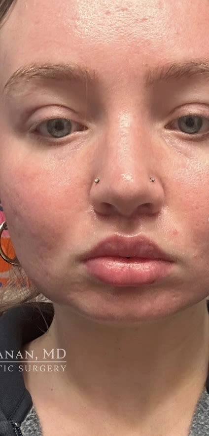 Lip Lift After, Female 23 - 3817