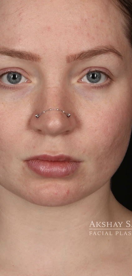 Lip Lift Before, Female 23 - 3817