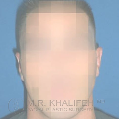 Otoplasty After, Male 29 - 3844