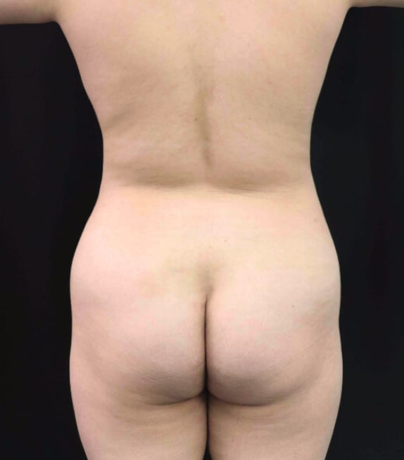 Brazilian Butt Lift Before, Female 33 - 3845