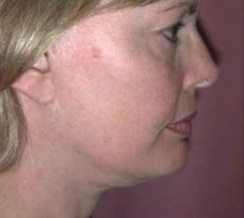 Neck Lift Before, Female 47 - 3883